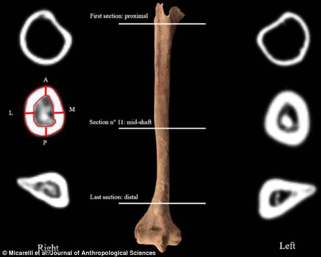 从图中可见，此人肱骨（位于上臂）存在严重骨磨损，该现象常见于佩戴假肢者。此外从前臂断裂处的角度可以看出，他的右手是被一刀斜着切下的。”